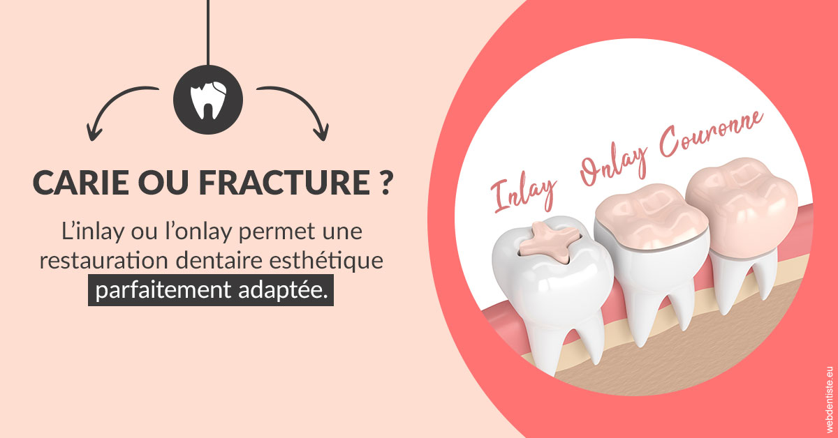 https://selarl-klejman.chirurgiens-dentistes.fr/T2 2023 - Carie ou fracture 2