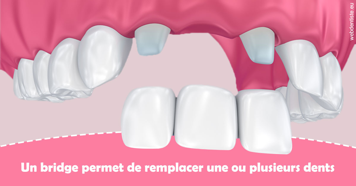 https://selarl-klejman.chirurgiens-dentistes.fr/Bridge remplacer dents 2