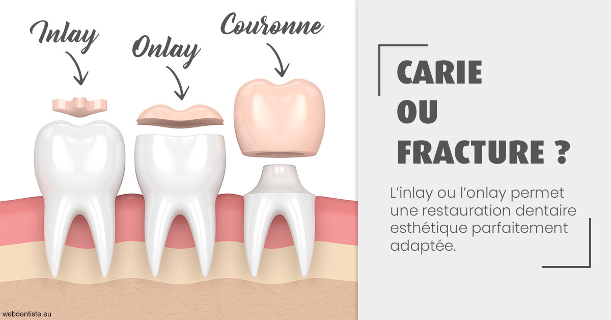 https://selarl-klejman.chirurgiens-dentistes.fr/T2 2023 - Carie ou fracture 1