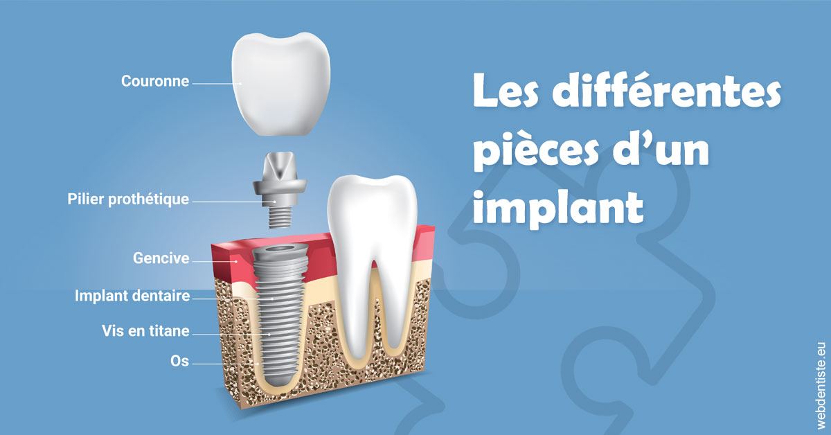 https://selarl-klejman.chirurgiens-dentistes.fr/Les différentes pièces d’un implant 1